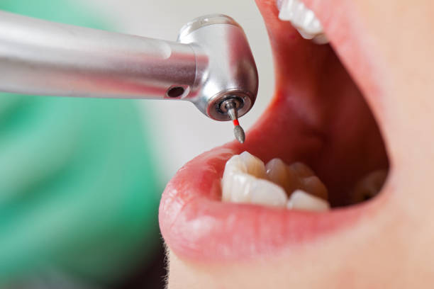 Best Emergency Tooth Extraction in Crestline, CA
